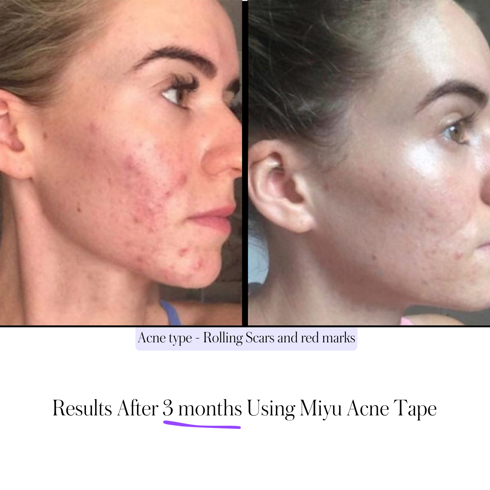 Miyu - Korean Acne Scar Tape